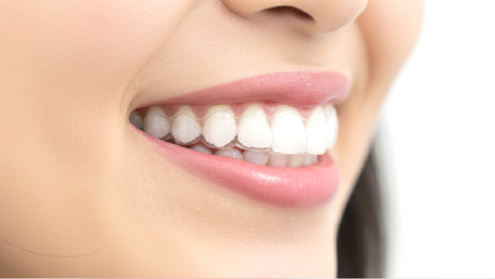 マウスピース型矯正歯科装置