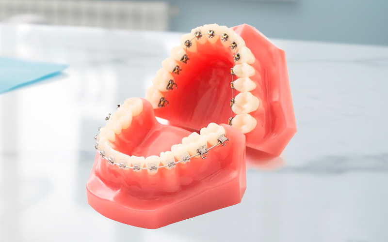 上：舌側矯正歯科装置下：表側矯正歯科装置